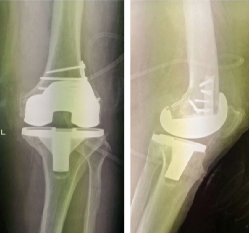 Почему колено после эндопротезирования. Перипротезный перелом тазобедренного сустава. Перипротезные переломы коленный сустав. Перипротезный перелом эндопротез коленного сустава. Модульный эндопротез коленного сустава.