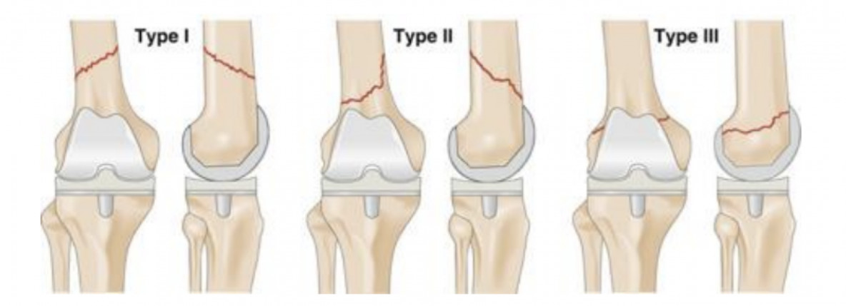 Перипротезные переломы дистального бедра и проксимальной