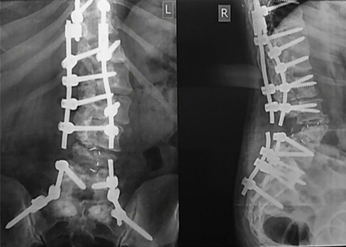 Пояснично крестцовый отдел операция на позвоночнике. Перелом с1 позвонка рентген. Транспедикулярный остеосинтез l4-l5. Перелом позвоночника остеосинтез рентген. Компрессионный перелом шейного отдела позвоночника рентген.