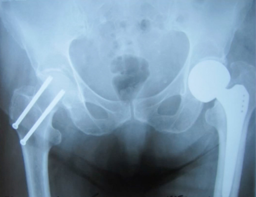 Симптомы шейки бедра как определить. Базальный перелом шейки бедра рентген. Перелом шейки бедра рентген. Перелом тазобедренного сустава. Перелом шейки бедра снимок.