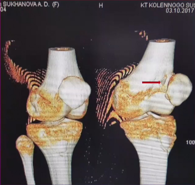 Острые вывихи надколенника. Диагностика. Принципы