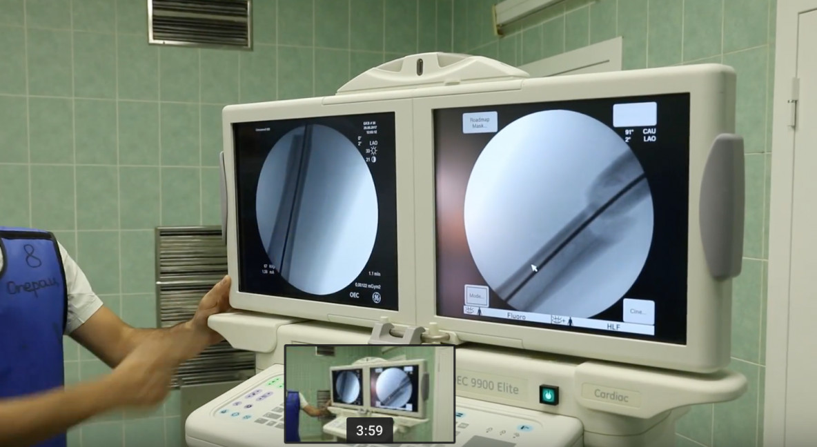 Закрытый блокируемый интрамедуллярный остеосинтез бедренной кости ...