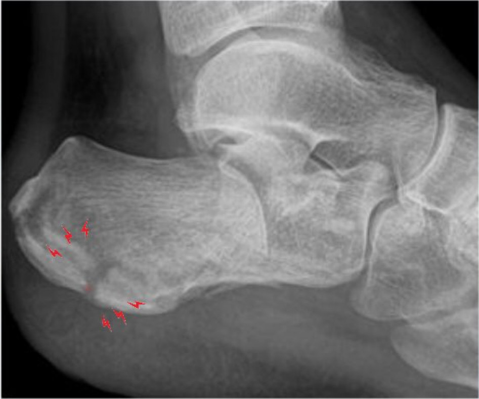 Перелом пятки. Перелом пяточной кости рентген. Клювовидный перелом пяточной кости. Внесуставной перелом пяточной кости. Краевой оскольчатый перелом пяточной кости.