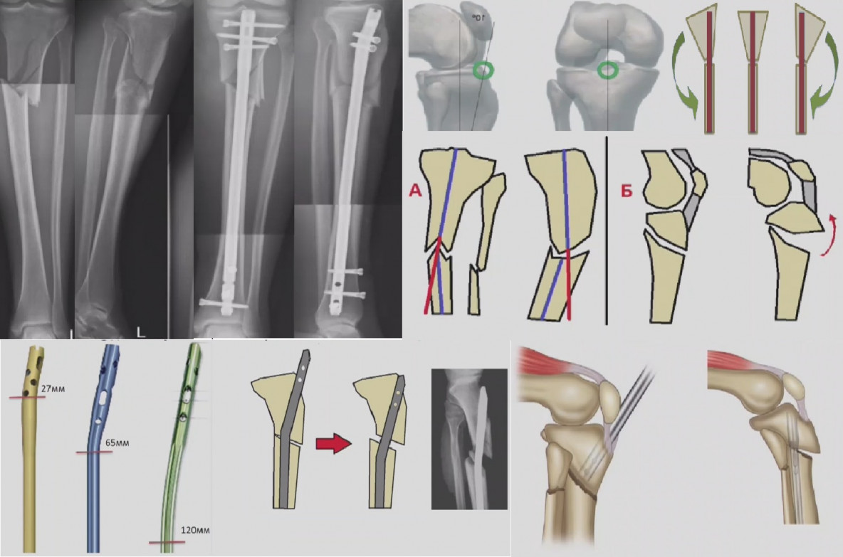 Интрамедуллярный остеосинтез проксимального отдела большеберцовой кости ...