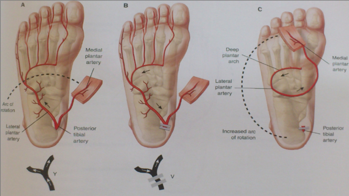 Медиальный подошвенный лоскут (medial plantar flap