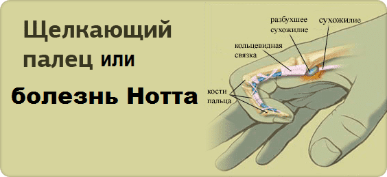 СТЕНОЗИРУЮЩИЙ ЛИГАМЕНТИТ. СТЕНОЗИРУЮЩИЙ ТЕНДОВАГИНИТ СГИБАТЕЛЕЙ ПАЛЬЦЕВ ...