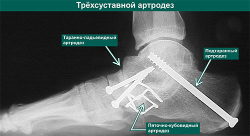 Артродез суставов операция. Таранно-ладьевидный артродез. Артродез голеностопного сустава рентген. Подтаранный сустав стопы. Подтаранный сустав артродез.